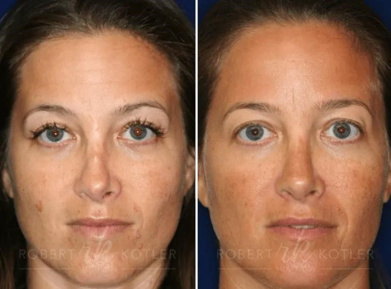 closed rhinoplasty